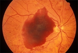 diabetic eye disease img2