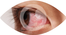 itching and redness - symptoms of an eye infection