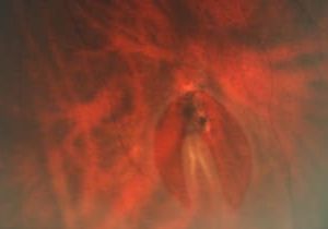 Laser Treatment of Retinal Tears and Detachments Singapore