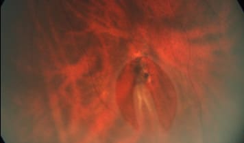 Laser Treatment of Retinal Tears and Detachments Singapore