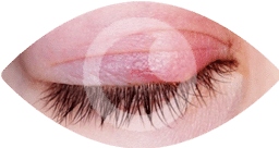 lump, redness, and pus - indicators of a stye