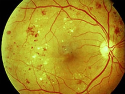 diabetic eye treatment Diabetic Eye Disease Treatment Singapore