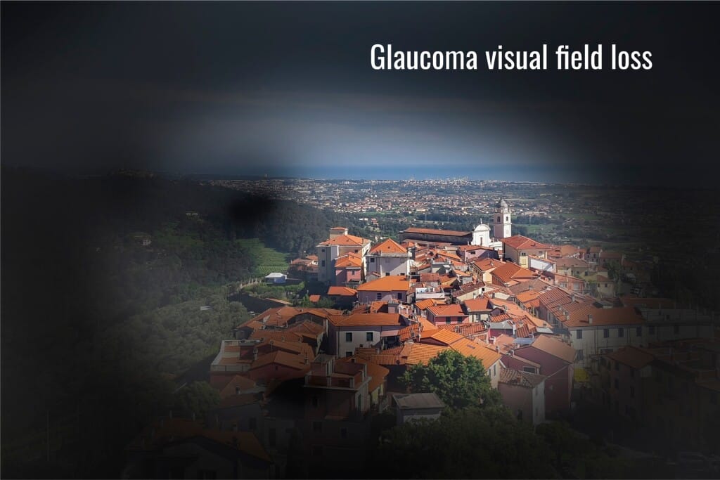 Glaucoma Visual Field Loss