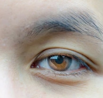 DROOPY EYELIDS (PTOSIS) Singapore
