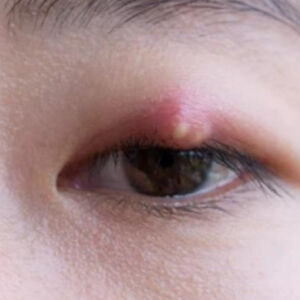 Stye (Chalazion & Hordeolum)