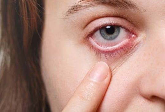 red eye