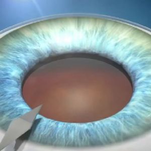 Cataract Surgery in Singapore