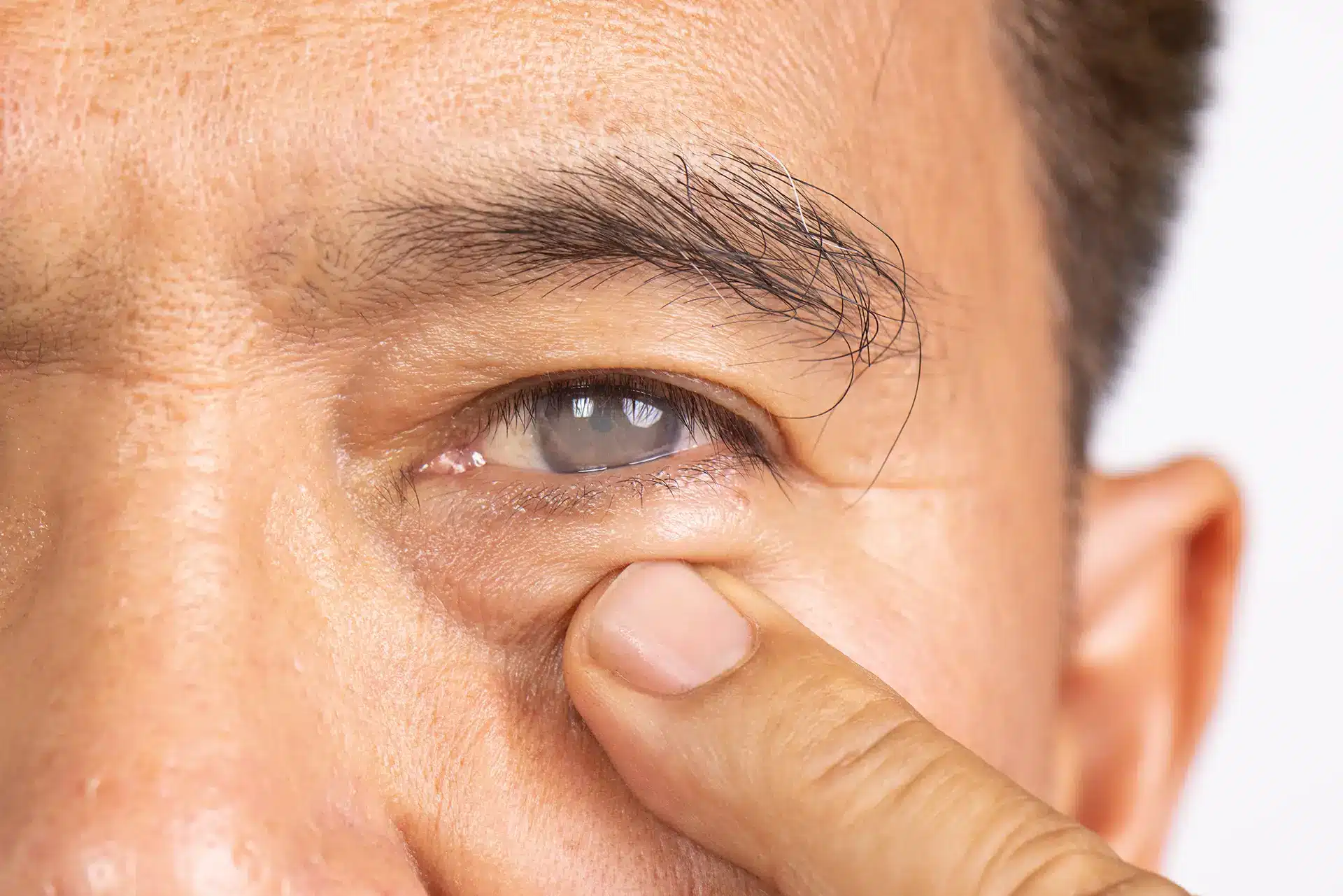 Cataract Surgery in Singapore - Eye Max Centre