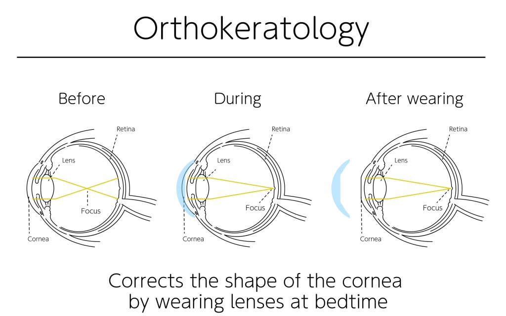 Orthokeratology eye condition before, during, and after treatment - Eye Max Centre