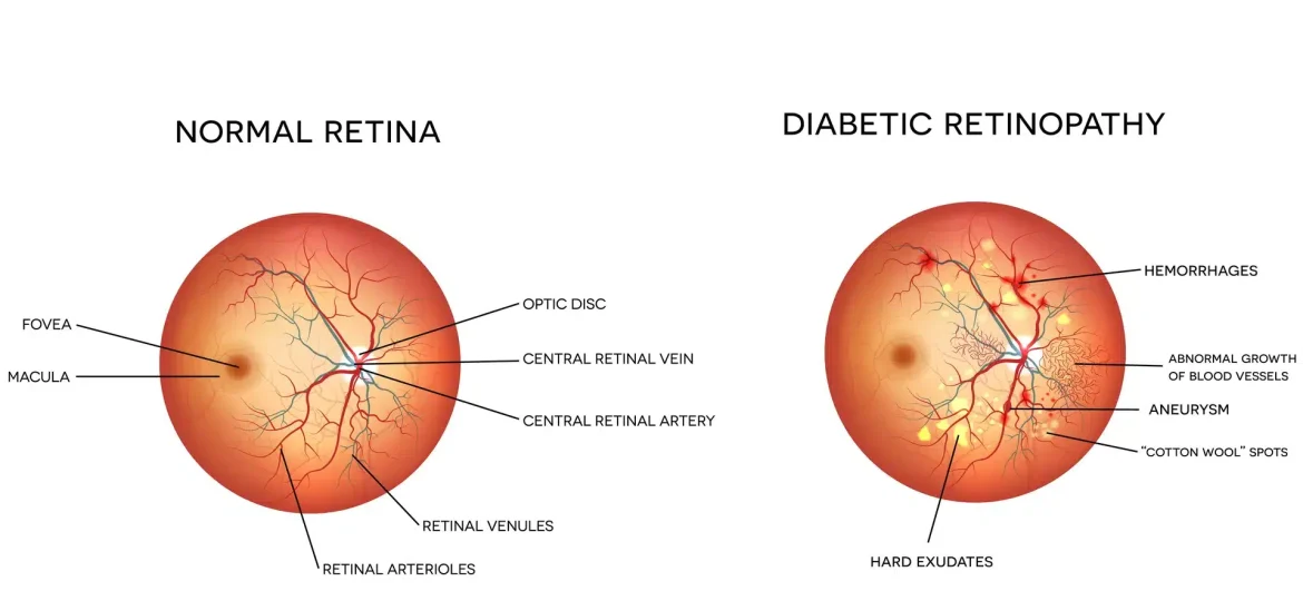Normal Retina vs Diabetic Retinopathy - Eye Max Centre