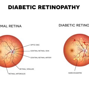 Normal Retina vs Diabetic Retinopathy - Eye Max Centre