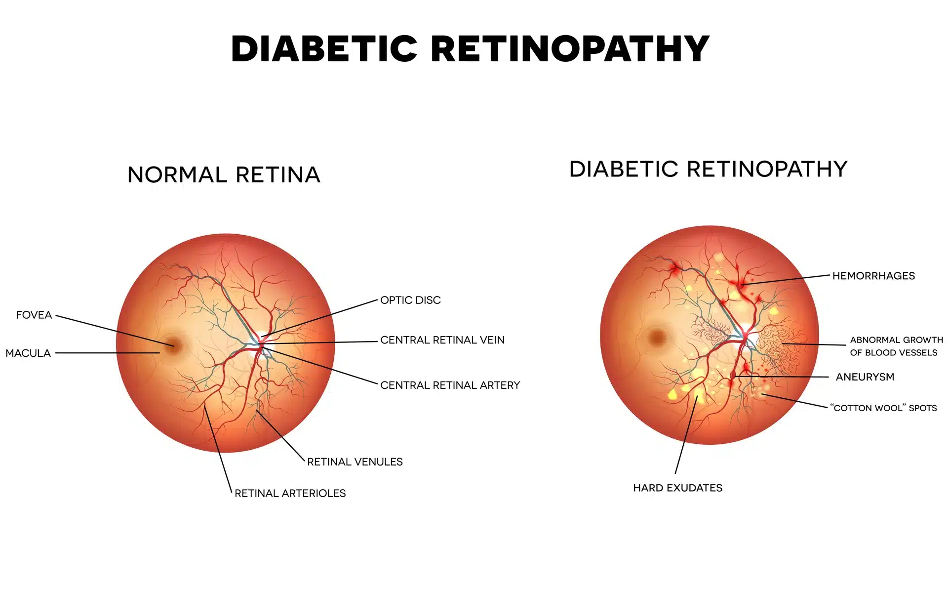 diabetic-retinopathy-diagram Normal Retina vs Diabetic Retinopathy - Eye Max Centre