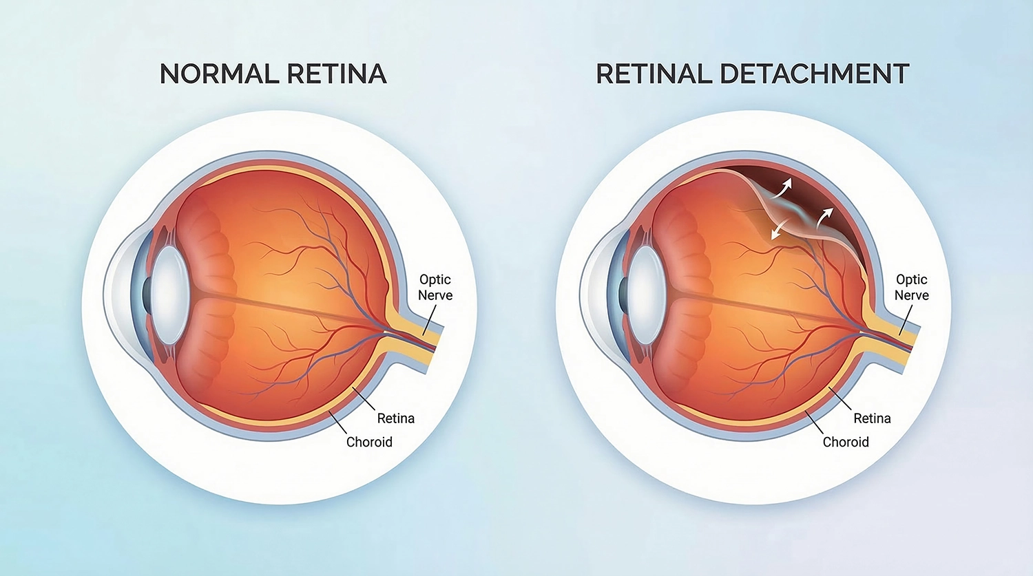 Retinal Detachment Eye Disease Anatomy Cross Section Diagram - Eye Max Centre Retinal Detachment Eye Disease Anatomy Cross Section Diagram - Eye Max Centre