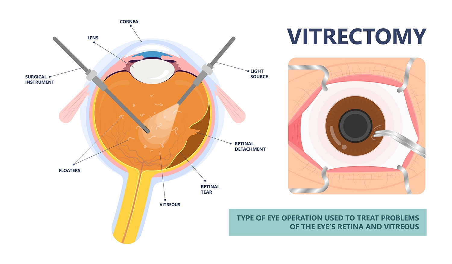 Vitrectomy - Eye Max Centre