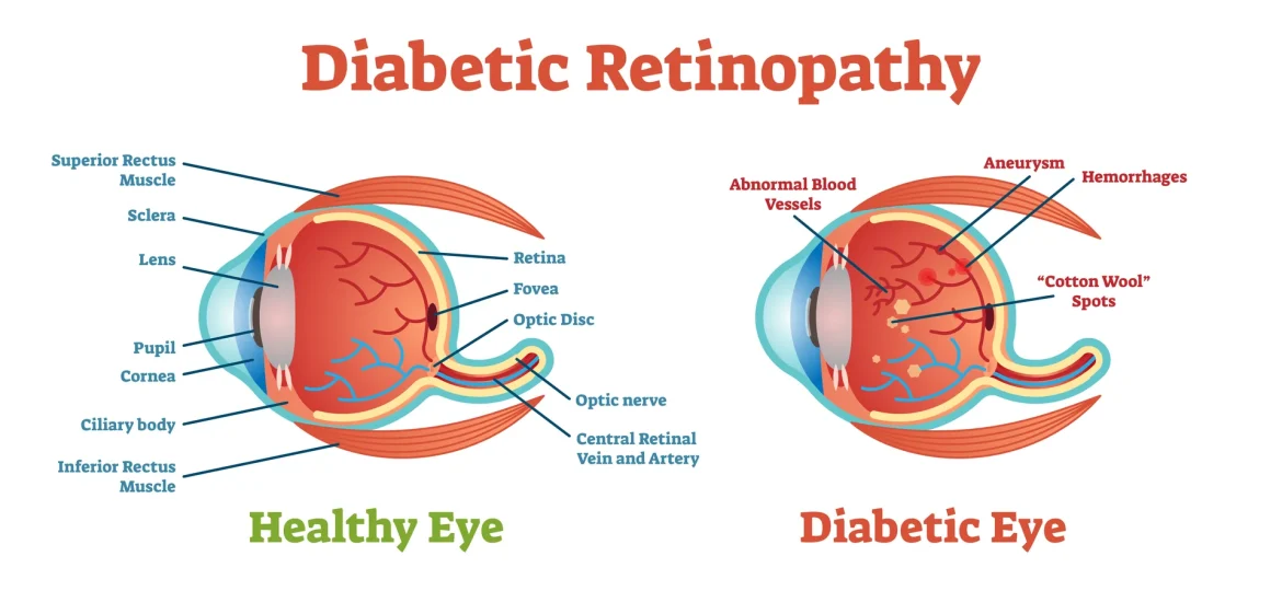 Comparison of a healthy eye and an eye with diabetic retinopathy, showing damaged retinal blood vessels - Eye Max Centre