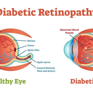 Comparison of a healthy eye and an eye with diabetic retinopathy, showing damaged retinal blood vessels - Eye Max Centre