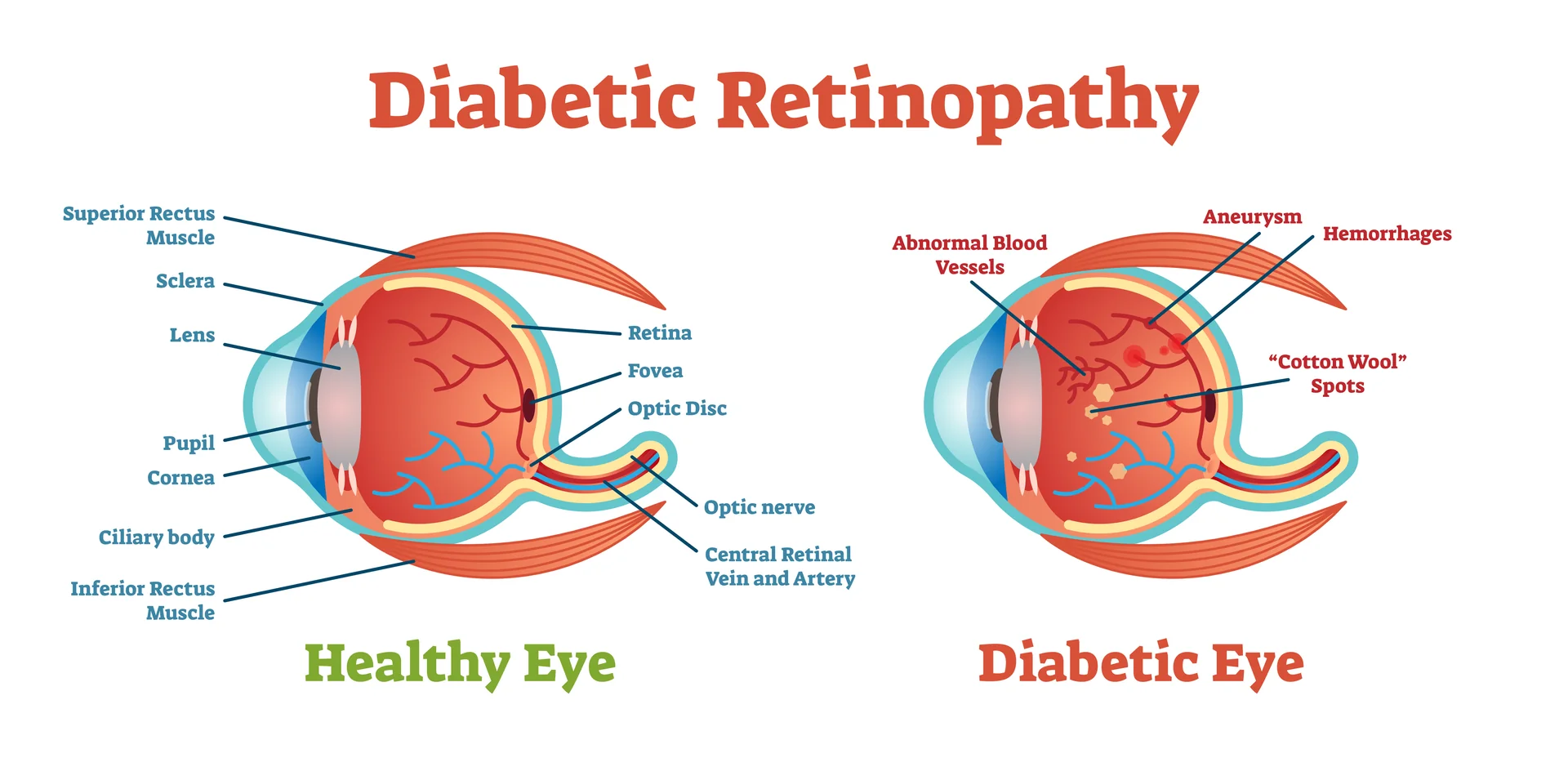 diabetic-retinopathy-eye-diagram Comparison of a healthy eye and an eye with diabetic retinopathy, showing damaged retinal blood vessels - Eye Max Centre