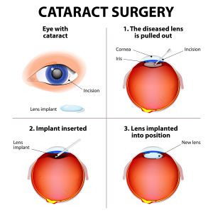 Cataract Surgery in Singapore - Eye Max Centre