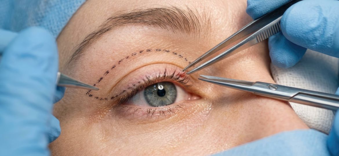 Droopy eyelid (ptosis) correction surgery with surgical instruments for medical or cosmetic reasons - Eye Max Centre